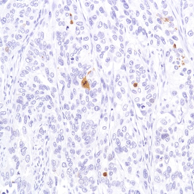 Immunohistochemistry (Formalin/PFA-fixed paraffin-embedded sections) - Anti-Cleaved PARP1 antibody [SP276] (AB225715), expandable thumbnail