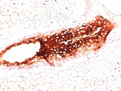 Immunohistochemistry (Formalin/PFA-fixed paraffin-embedded sections) - Anti-Cytokeratin 17 antibody [SPM560] - BSA and Azide free (AB212552), expandable thumbnail