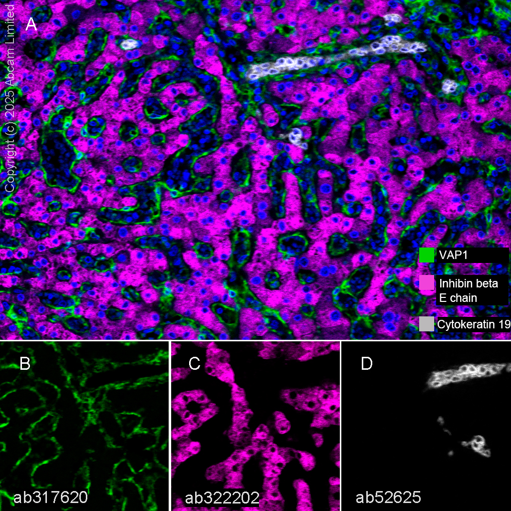 Multiplex immunohistochemistry - Anti-Cytokeratin 19 antibody [EP1580Y] - Cytoskeleton Marker (ab52625), expandable thumbnail