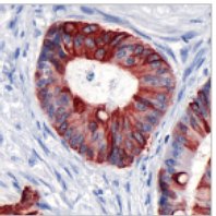 Immunohistochemistry (Formalin/PFA-fixed paraffin-embedded sections) - Anti-Cytokeratin 20 antibody [SP33] (ab64090), expandable thumbnail