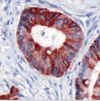 Immunohistochemistry (Formalin/PFA-fixed paraffin-embedded sections) - Anti-Cytokeratin 20 antibody [SP33], prediluted (AB64091), expandable thumbnail