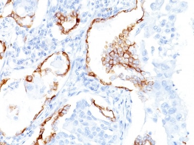 Immunohistochemistry (Formalin/PFA-fixed paraffin-embedded sections) - Anti-Cytokeratin 7 antibody [K72.7] (AB233904), expandable thumbnail