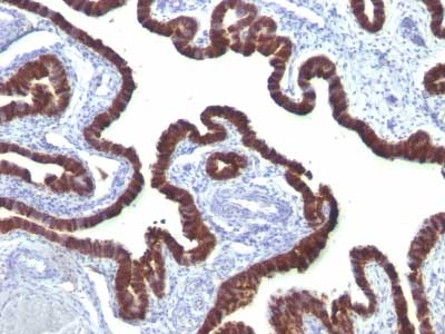 Immunohistochemistry (Formalin/PFA-fixed paraffin-embedded sections) - Anti-Cytokeratin 7 antibody [OV-TL12/30] (AB216016), expandable thumbnail