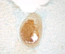 Immunohistochemistry (Formalin/PFA-fixed paraffin-embedded sections) - Anti-Cytokeratin 7 antibody [RCK105] - Cytoskeleton Marker (AB9021)