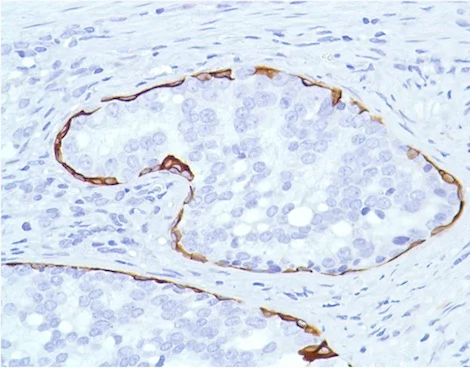 Immunohistochemistry (Formalin/PFA-fixed paraffin-embedded sections) - Anti-Cytokeratin 7 antibody [SP52] (AB183344)