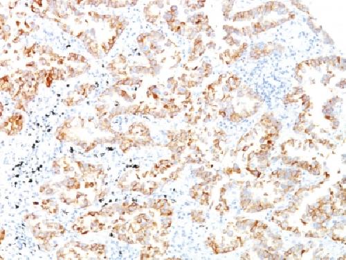 Immunohistochemistry (Formalin/PFA-fixed paraffin-embedded sections) - Anti-Cytokeratin 7 antibody [SPM270] - BSA and Azide free (AB212526)