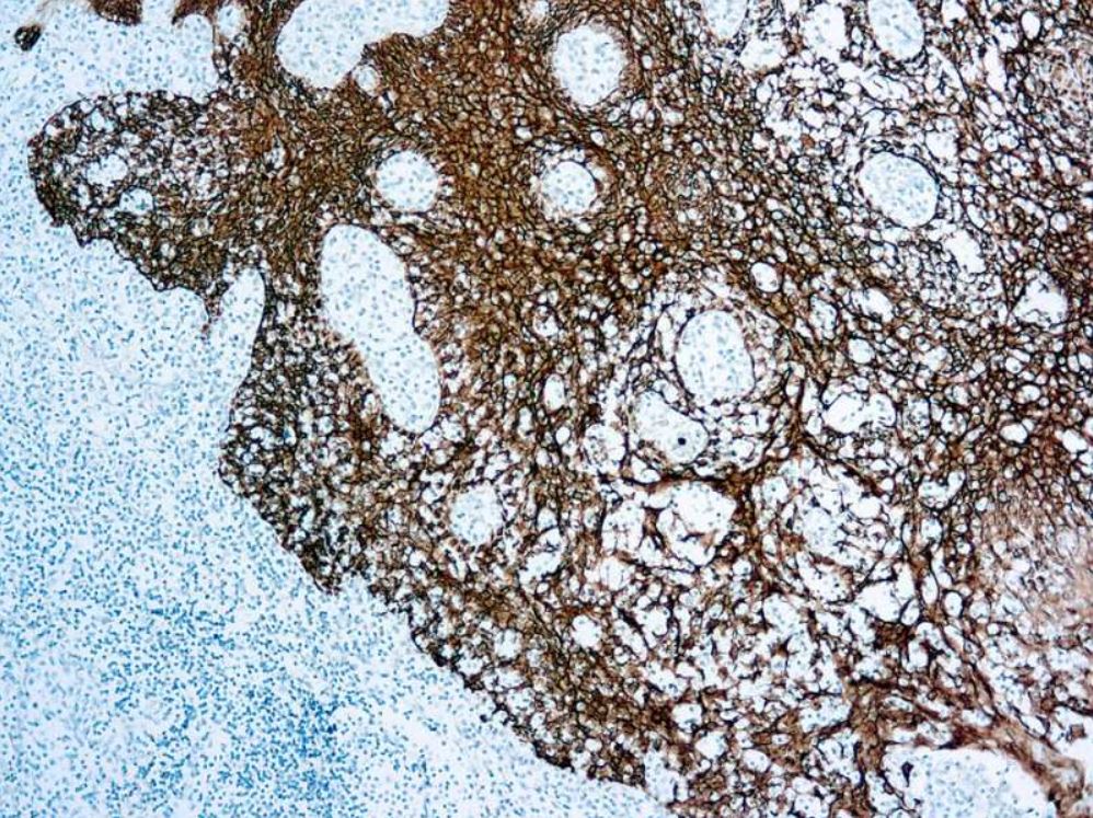 Immunohistochemistry (Formalin/PFA-fixed paraffin-embedded sections) - Anti-Cytokeratin antibody [MNF116], prediluted (AB82612), expandable thumbnail