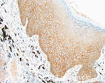 Immunohistochemistry (Formalin/PFA-fixed paraffin-embedded sections) - Anti-Desmoglein 3/PVA antibody [5G11] (AB14416), expandable thumbnail