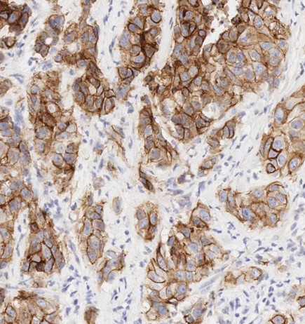 Immunohistochemistry (Formalin/PFA-fixed paraffin-embedded sections) - Anti-E Cadherin antibody [EP700Y] - Low endotoxin, Azide free (AB201499), expandable thumbnail