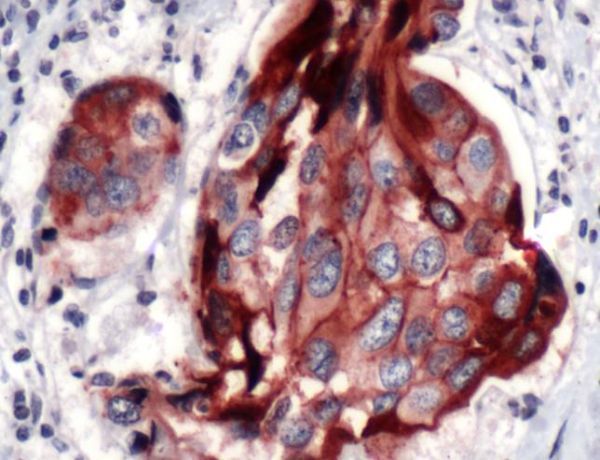 Immunohistochemistry (Formalin/PFA-fixed paraffin-embedded sections) - Anti-E Cadherin antibody [SP64] (AB227639), expandable thumbnail
