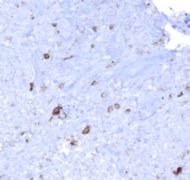 Immunohistochemistry (Formalin/PFA-fixed paraffin-embedded sections) - Anti-EBV Latent Membrane Protein 1 antibody [CS1, CS2, CS3, CS4], prediluted (AB7502)