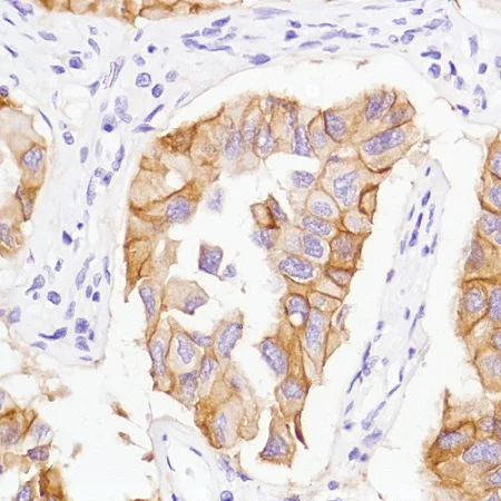 Immunohistochemistry (Formalin/PFA-fixed paraffin-embedded sections) - Anti-EGFR (mutated L858R) antibody [SP125] (AB227647)