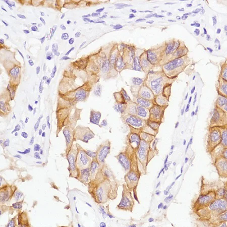 Immunohistochemistry (Formalin/PFA-fixed paraffin-embedded sections) - Anti-EGFR (mutated L858R) antibody [SP125] - BSA and Azide free (AB238773)
