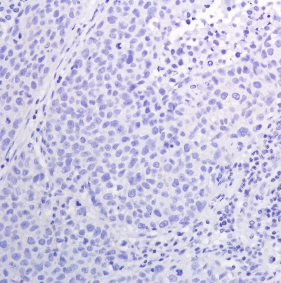 Immunohistochemistry (Formalin/PFA-fixed paraffin-embedded sections) - Anti-EGFR (phospho Y1068) antibody [SP353] (ab223499), expandable thumbnail