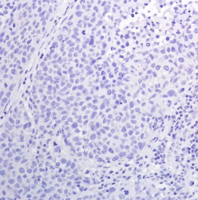 Immunohistochemistry (Formalin/PFA-fixed paraffin-embedded sections) - Anti-EGFR (phospho Y1068) antibody [SP353] - BSA and Azide free (AB242417)