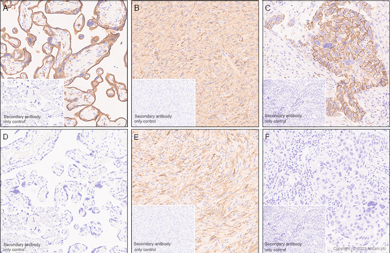 Immunohistochemistry (Formalin/PFA-fixed paraffin-embedded sections) - Anti-EGFRvIII antibody [EPR28380-83] (ab313646), expandable thumbnail