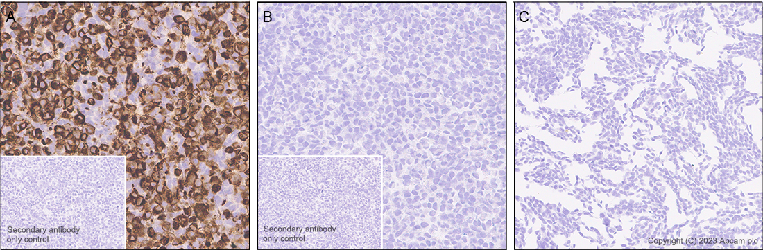 Immunohistochemistry (Formalin/PFA-fixed paraffin-embedded sections) - Anti-EGFRvIII antibody [EPR28380-83] (ab313646), expandable thumbnail