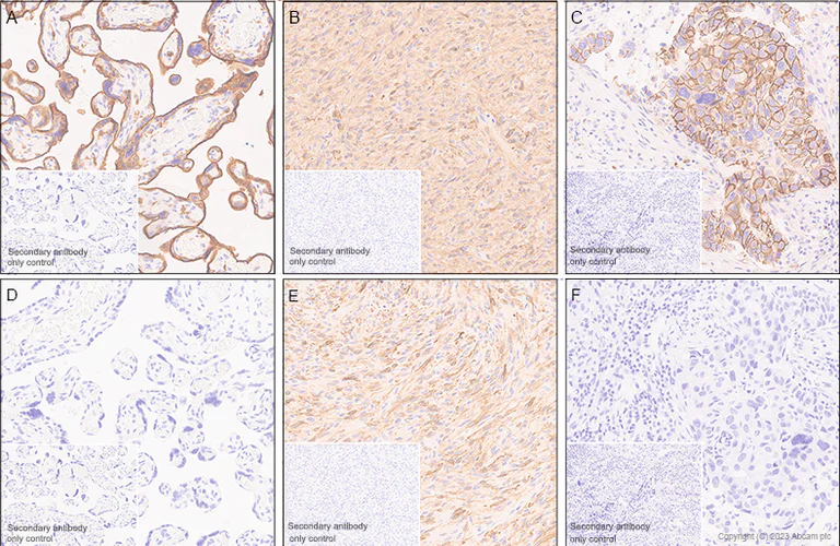 Immunohistochemistry (Formalin/PFA-fixed paraffin-embedded sections) - Anti-EGFRvIII antibody [EPR28380-83] - BSA and Azide free (AB313647)