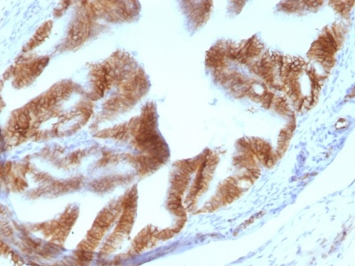 Immunohistochemistry (Formalin/PFA-fixed paraffin-embedded sections) - Anti-EpCAM antibody [EGP40/1110] (AB233919), expandable thumbnail