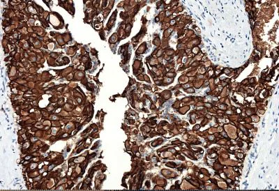 Immunohistochemistry (Formalin/PFA-fixed paraffin-embedded sections) - Anti-ErbB2 / HER2 antibody [CAL27] - BSA and Azide free (AB251602)
