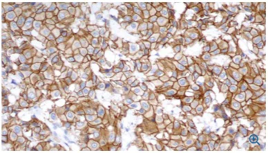 Immunohistochemistry (Formalin/PFA-fixed paraffin-embedded sections) - Anti-ErbB2 / HER2 antibody [CB11] (AB8054)
