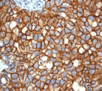 Immunohistochemistry (Formalin/PFA-fixed paraffin-embedded sections) - Anti-ErbB2 / HER2 antibody [EP1045Y] (ab134182), expandable thumbnail