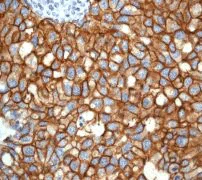 Immunohistochemistry (Formalin/PFA-fixed paraffin-embedded sections) - Anti-ErbB2 / HER2 antibody [EP1045Y] - BSA and Azide free (AB194979)