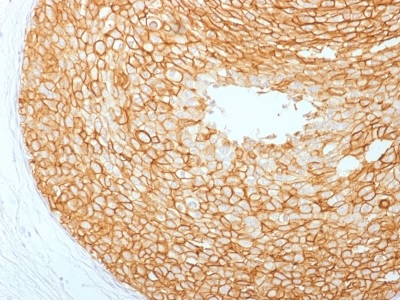 Immunohistochemistry (Formalin/PFA-fixed paraffin-embedded sections) - Anti-ErbB2 / HER2 antibody [ERBB2/2453] (AB237993), expandable thumbnail