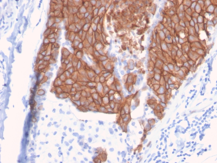 Immunohistochemistry (Formalin/PFA-fixed paraffin-embedded sections) - Anti-ErbB2 / HER2 antibody [ERBB2/3093] (AB268053), expandable thumbnail