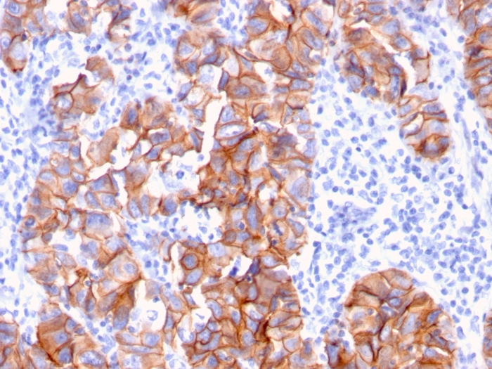 Immunohistochemistry (Formalin/PFA-fixed paraffin-embedded sections) - Anti-ErbB2 / HER2 antibody [ERBB2/3093] (AB268053), expandable thumbnail
