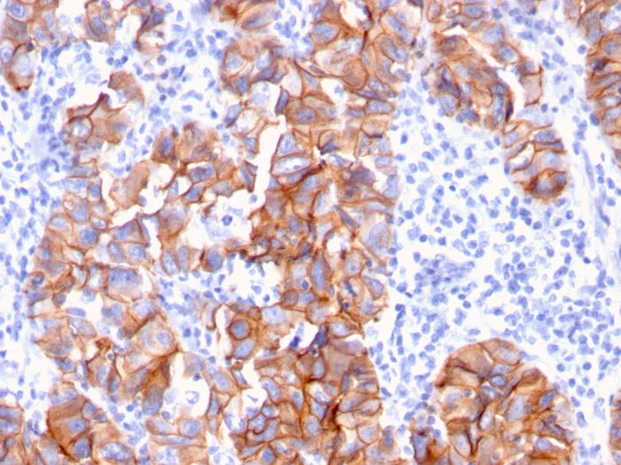 Immunohistochemistry (Formalin/PFA-fixed paraffin-embedded sections) - Anti-ErbB2 / HER2 antibody [ERBB2/3093] (AB268053)