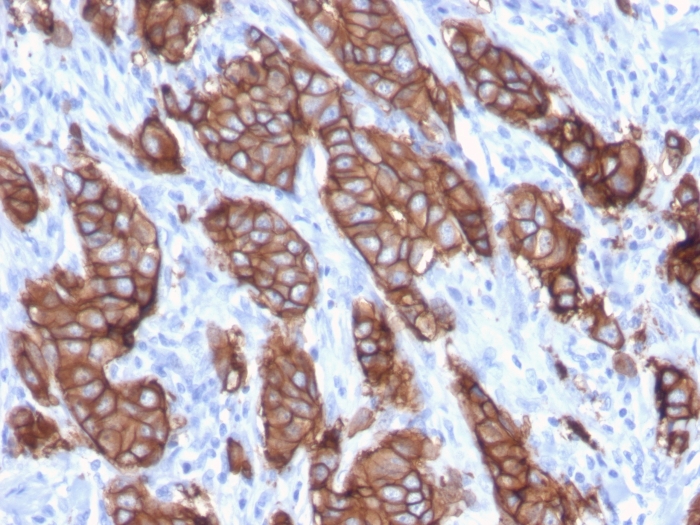 Immunohistochemistry (Formalin/PFA-fixed paraffin-embedded sections) - Anti-ErbB2 / HER2 antibody [ERBB2/3093] (AB268053), expandable thumbnail