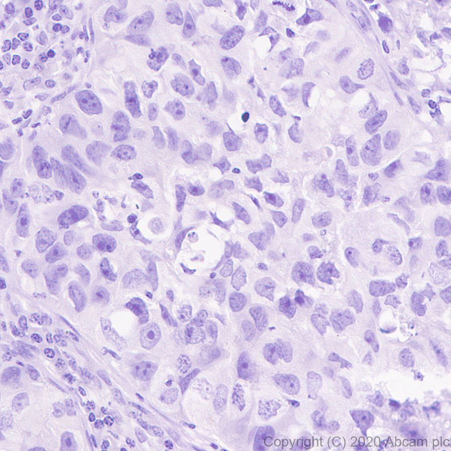 Immunohistochemistry (Formalin/PFA-fixed paraffin-embedded sections) - Anti-ErbB2 / HER2 antibody [ICR12] (AB11710), expandable thumbnail