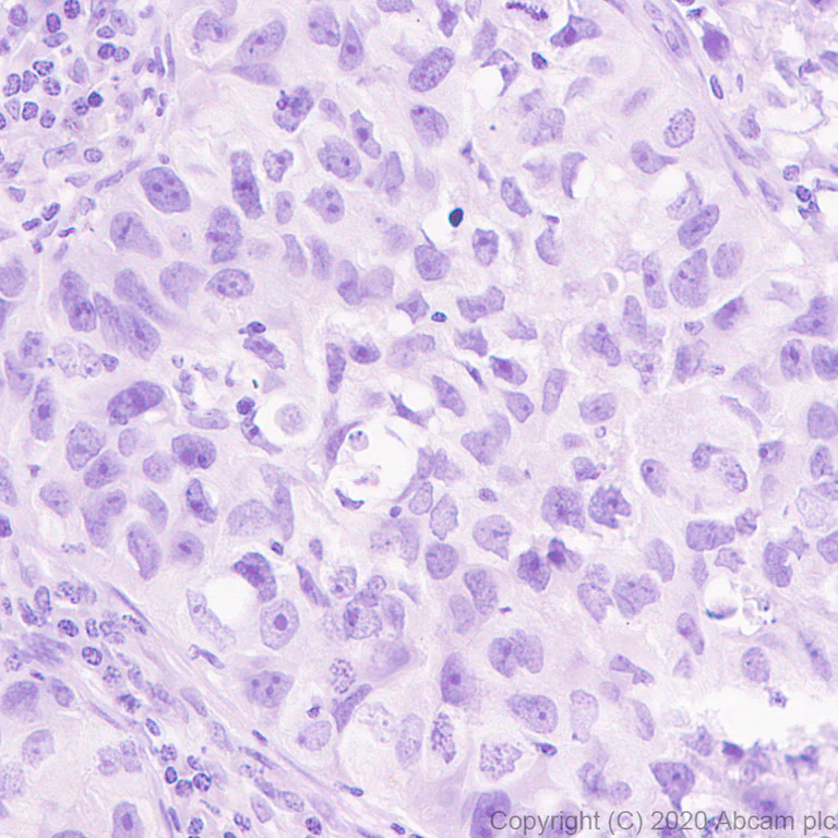 Immunohistochemistry (Formalin/PFA-fixed paraffin-embedded sections) - Anti-ErbB2 / HER2 antibody [ICR12] (AB11710)