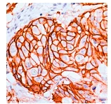 Immunohistochemistry (Formalin/PFA-fixed paraffin-embedded sections) - Anti-ErbB2 / HER2 antibody [SP3], prediluted (AB27597)