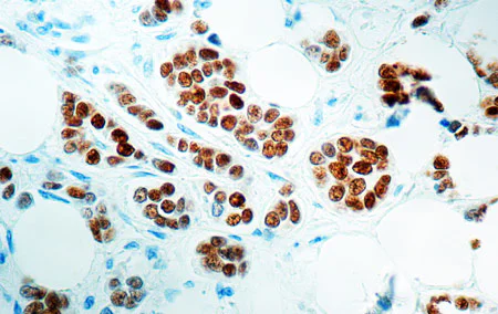 Immunohistochemistry (Formalin/PFA-fixed paraffin-embedded sections) - Anti-Estrogen Receptor alpha antibody [6F11] (AB93021)