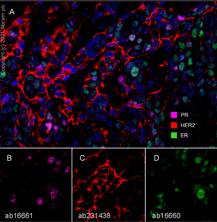 Multiplex immunohistochemistry - Anti-Estrogen Receptor alpha antibody [SP1] - BSA and Azide free (ab187260), expandable thumbnail