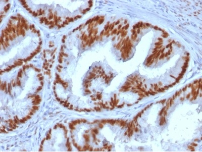 Immunohistochemistry (Formalin/PFA-fixed paraffin-embedded sections) - Anti-Estrogen Receptor antibody [ESR1/1935] (AB237995), expandable thumbnail