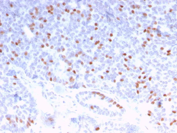 Immunohistochemistry (Formalin/PFA-fixed paraffin-embedded sections) - Anti-Estrogen Receptor antibody [ESR1/3373] - BSA and Azide free (AB268175)