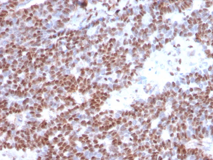 Immunohistochemistry (Formalin/PFA-fixed paraffin-embedded sections) - Anti-Estrogen Receptor antibody [ESR1/3373] - BSA and Azide free (AB268175)