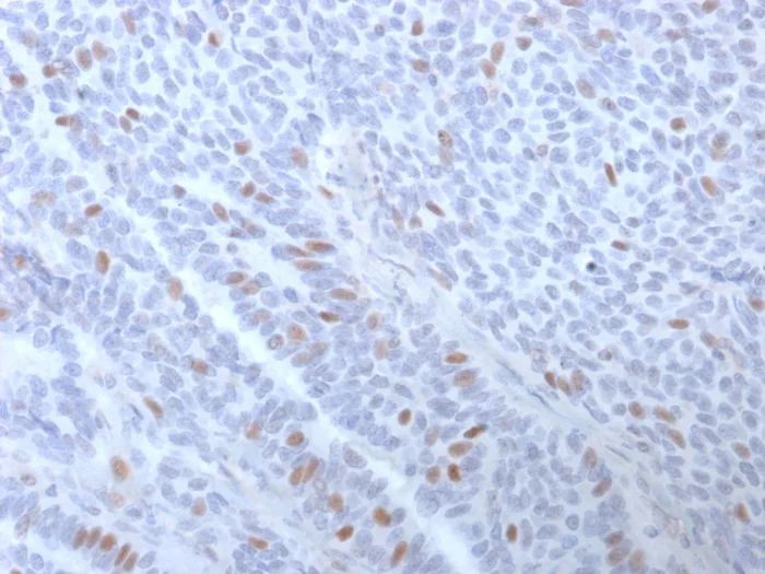 Immunohistochemistry (Formalin/PFA-fixed paraffin-embedded sections) - Anti-Estrogen Receptor antibody [ESR1/3373] - BSA and Azide free (AB268175)
