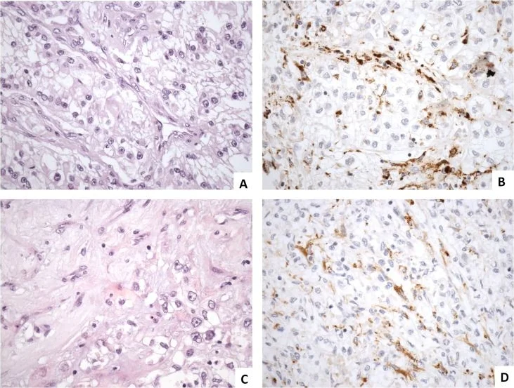 Immunohistochemistry (Formalin/PFA-fixed paraffin-embedded sections) - Anti-Fibroblast activation protein, alpha antibody (AB53066)