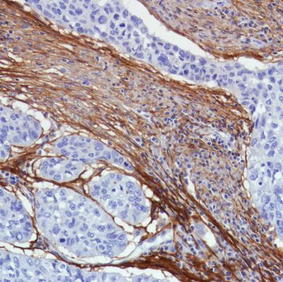 Immunohistochemistry (Formalin/PFA-fixed paraffin-embedded sections) - Anti-Fibroblast activation protein, alpha antibody [SP325] (AB227703)