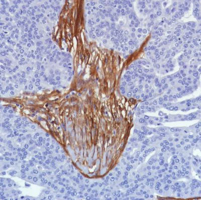 Immunohistochemistry (Formalin/PFA-fixed paraffin-embedded sections) - Anti-Fibroblast activation protein, alpha antibody [SP325] - BSA and Azide free (AB240989)