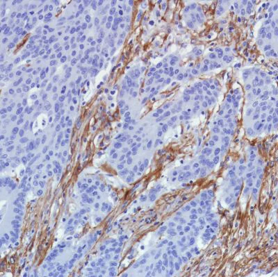 Immunohistochemistry (Formalin/PFA-fixed paraffin-embedded sections) - Anti-Fibroblast activation protein, alpha antibody [SP325] - BSA and Azide free (AB240989)
