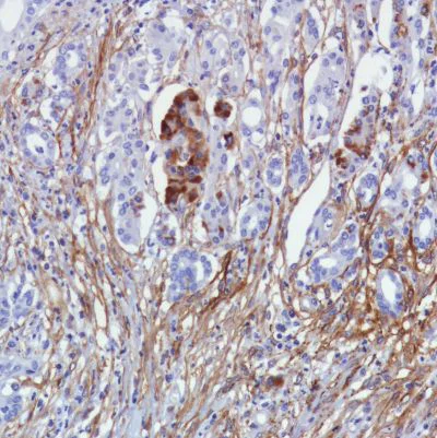 Immunohistochemistry (Formalin/PFA-fixed paraffin-embedded sections) - Anti-Fibroblast activation protein, alpha antibody [SP325] - BSA and Azide free (AB240989)