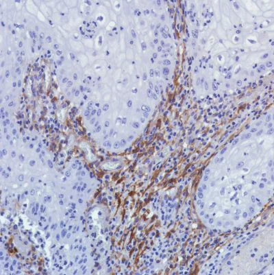 Immunohistochemistry (Formalin/PFA-fixed paraffin-embedded sections) - Anti-Fibroblast activation protein, alpha antibody [SP325] - BSA and Azide free (AB240989)