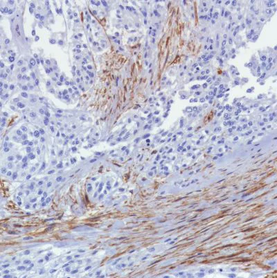 Immunohistochemistry (Formalin/PFA-fixed paraffin-embedded sections) - Anti-Fibroblast activation protein, alpha antibody [SP325] - BSA and Azide free (AB240989)
