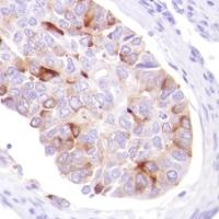 Immunohistochemistry (Formalin/PFA-fixed paraffin-embedded sections) - Anti-GCDFP 15 antibody [SP185] - C-terminal (AB183321), expandable thumbnail