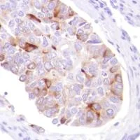 Immunohistochemistry (Formalin/PFA-fixed paraffin-embedded sections) - Anti-GCDFP 15 antibody [SP185] - C-terminal (AB183321)
